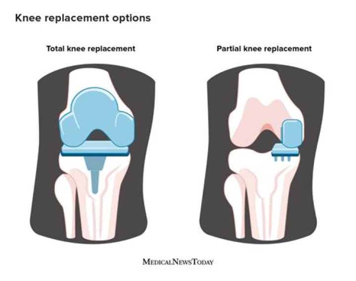 Does social security cover knee replacement?
