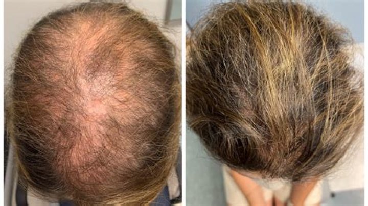 Is there a pill to stop hair growth?