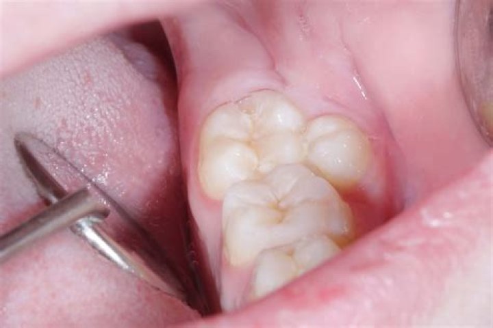 What you mean by supernumerary?